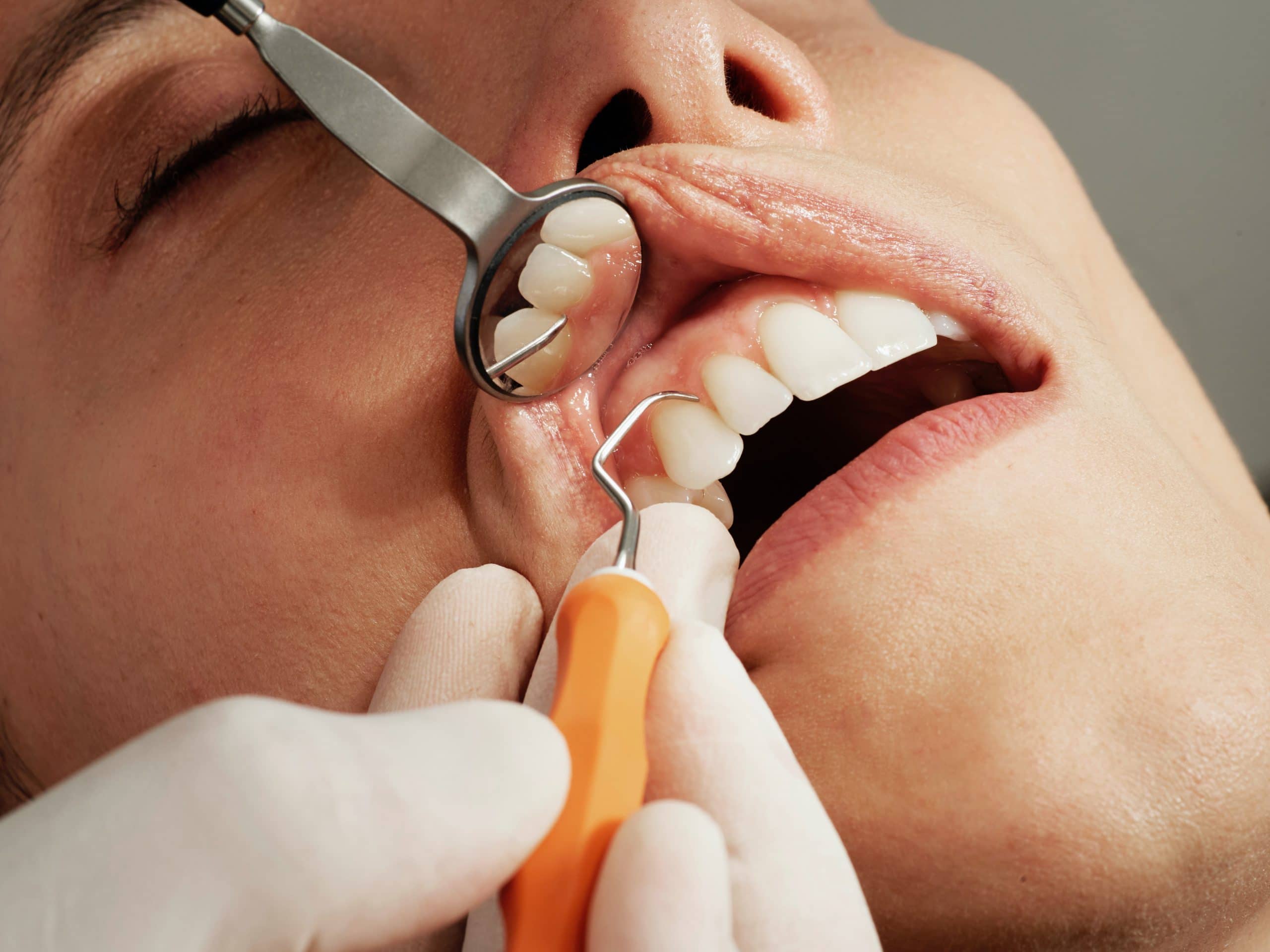 dik metaal hoed Ontstoken tandvlees behandelen, zo doe je dat! | KT3 tandartsen